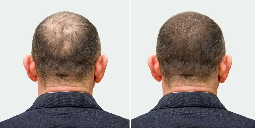 Hair Loss