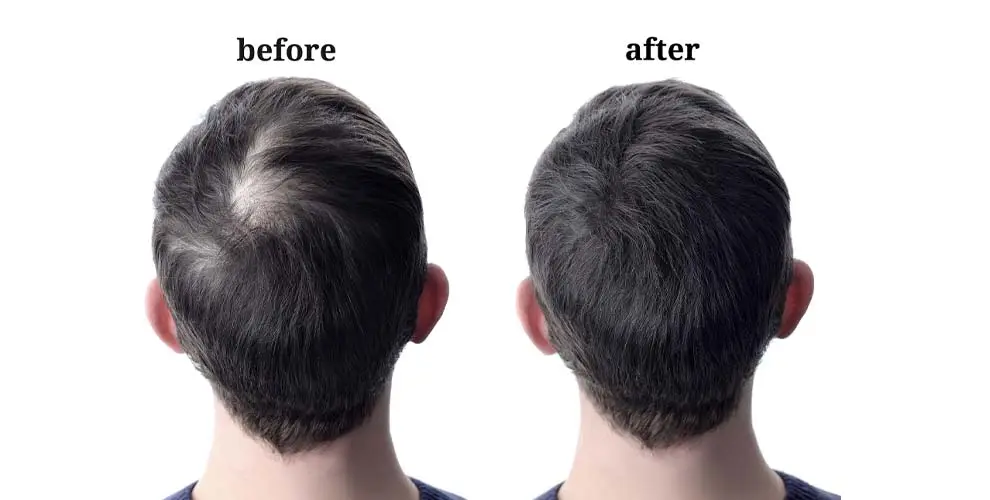 Hair Loss