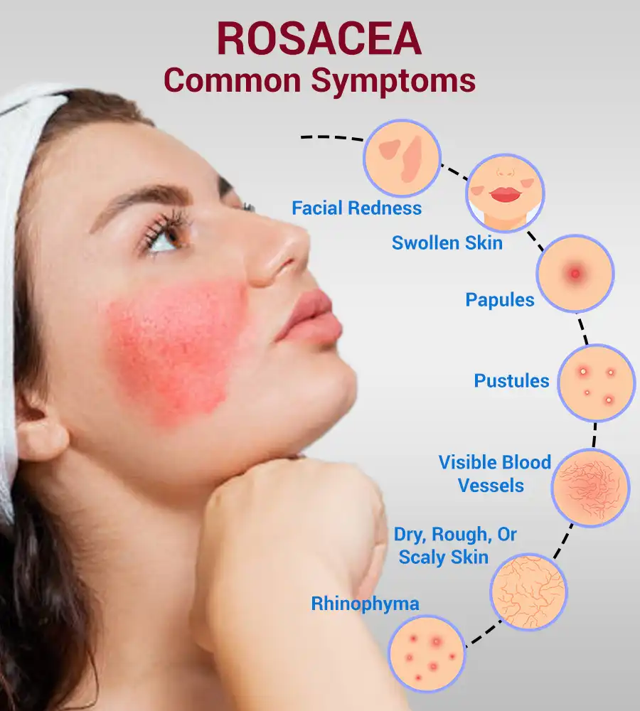 Red Light Therapy For Rosacea