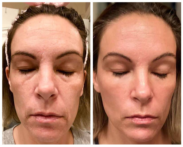 HigherDOSE Red Light Face Mask Before and After