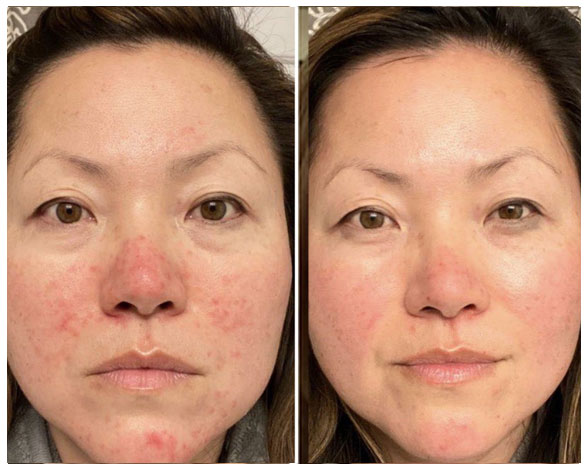 Omnilux before and after