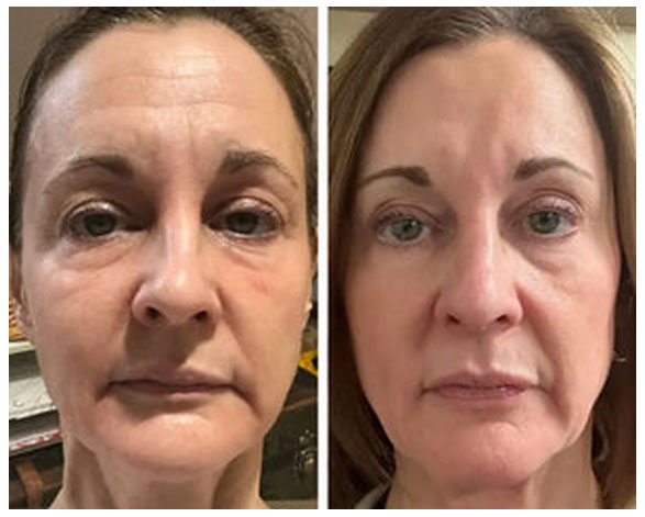 Omnilux review before and after