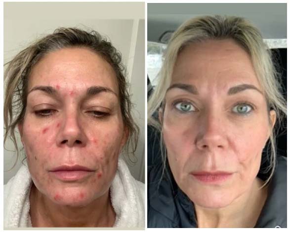 Qure before and after