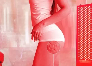 Terapia de luz roja para la celulitis y las estrías: beneficios y tratamiento