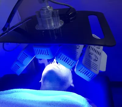 avanti body acne scars treatment