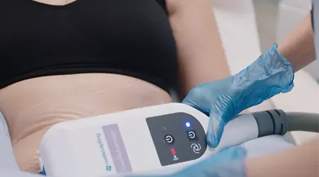 coolsculpting