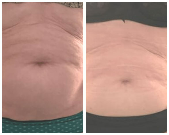nushape lipo wrap review before and after