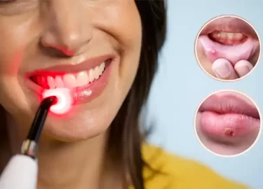 Terapia con luz roja para el herpes labial, según los expertos