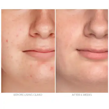spa sciences claro before and after